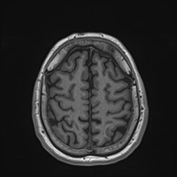 File:Cochlear incomplete partition type III associated with hypothalamic hamartoma (Radiopaedia 88756-105498 Axial T1 156).jpg