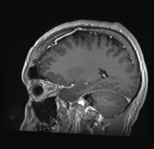 Cochlear incomplete partition type III associated with hypothalamic hamartoma (Radiopaedia 88756-105498 Sagittal T1 C+ 19).jpg