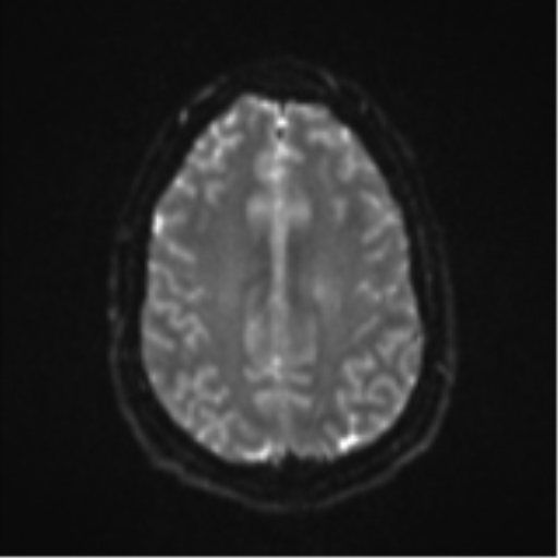 File:Colloid cyst (Radiopaedia 53164-59125 Axial DWI 22).png