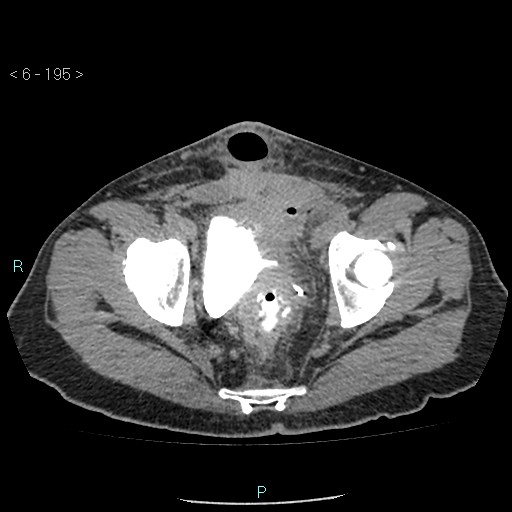 File:Colo-cutaneous fistula (Radiopaedia 40531-43129 A 81).jpg