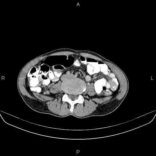 File:Colon adenocarcinoma - hepatic flexure (Radiopaedia 85635-101395 Axial C+ delayed 56).jpg