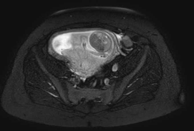 Colon adenocarcinoma with Krukenberg tumors, advanced pregnancy (Radiopaedia 67279-76645 Axial T2 SPAIR 20).jpg