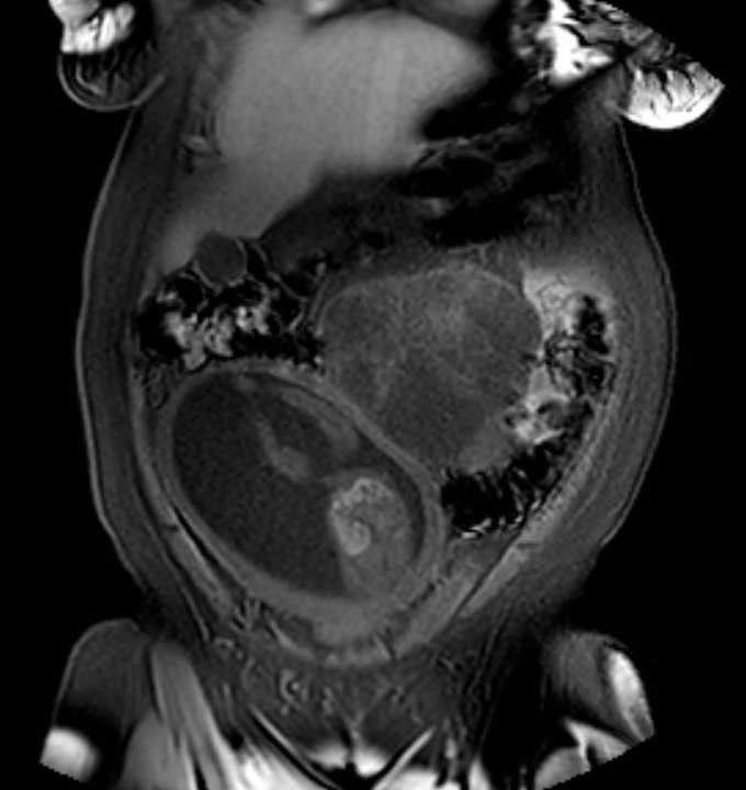 Colon adenocarcinoma with Krukenberg tumors, advanced pregnancy (Radiopaedia 67279-76645 E 17).jpg