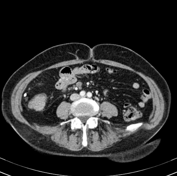 Colon carcinoma with hepatic metastases (Radiopaedia 29477-29961 A 68).jpg
