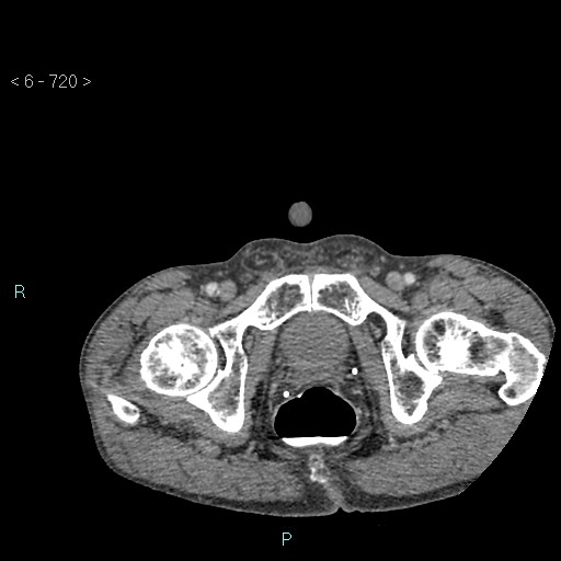 File:Colonic cancer (ultrasound and TC imaging) (Radiopaedia 50346-55713 A 146).jpg