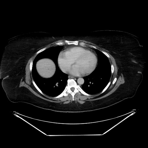 File:Colonic intussusception due to adenocarcinoma (Radiopaedia 86828-102987 A 10).jpg