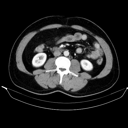 Colonic lipoma with colo-colic intussusception (Radiopaedia 58944-66200 A 33).jpg