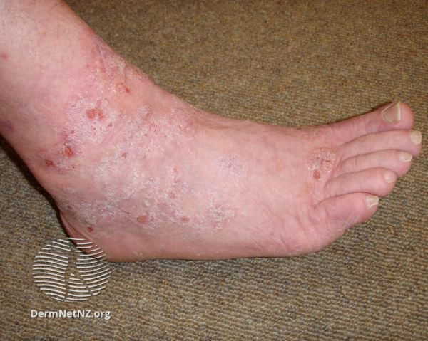 File:Contact dermatitis due to neoprene and diethylthiourea allergy (DermNet NZ dermatitis-diethylthiourea-allergy2).jpg