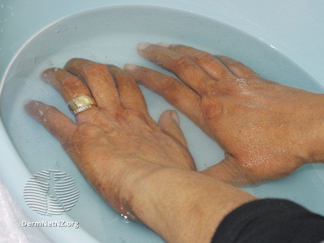 File:Hands and feet PUVA soaks (DermNet NZ procedures-bw-puva2).jpg