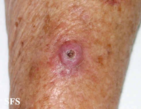 File:Keratoacanthoma (Dermatology Atlas 53).jpg