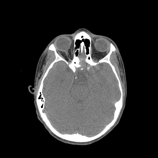Nasal pyogenic granuloma (lobular capillary hemangioma) (Radiopaedia 85536-101244 Axial non-contrast 106).jpg