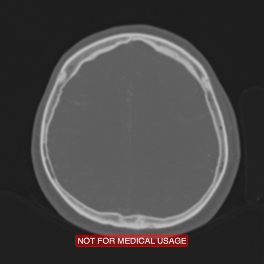 Nasopharyngeal carcinoma recurrence - skull base destruction (Radiopaedia 29107-29490 Axial bone window 32).jpg