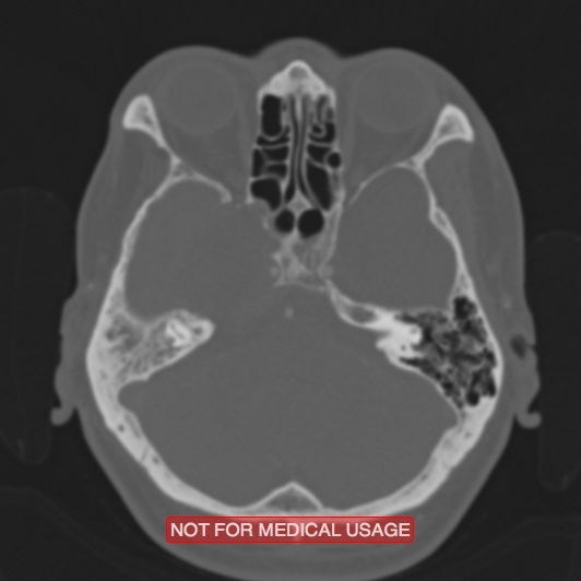 File:Nasopharyngeal carcinoma recurrence - skull base destruction (Radiopaedia 29107-29490 Axial bone window 78).jpg