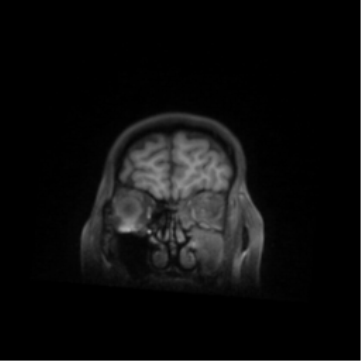 File:Nasopharyngeal carcinoma with cerebral abscess (Radiopaedia 43018-46274 Coronal T1 fat sat 11).png