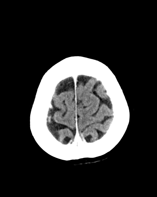 Nasopharyngeal carcinoma with cerebral abscess (Radiopaedia 43018-46275 Axial C+ delayed 45).png