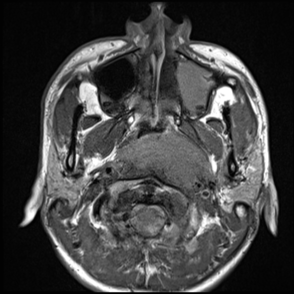 Nasopharyngeal carcinoma with skull base invasion (Radiopaedia 53415-59485 Axial T1 31).jpg