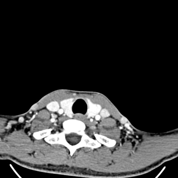 Nasopharyngeal carcinoma with skull base invasion (Radiopaedia 53415-59705 A 176).jpg