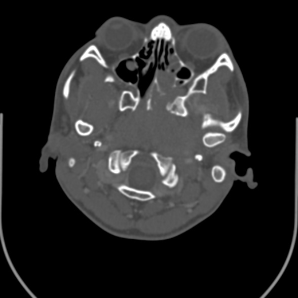 Nasopharyngeal carcinoma with skull base invasion (Radiopaedia 53415-59705 Axial bone window 34).jpg