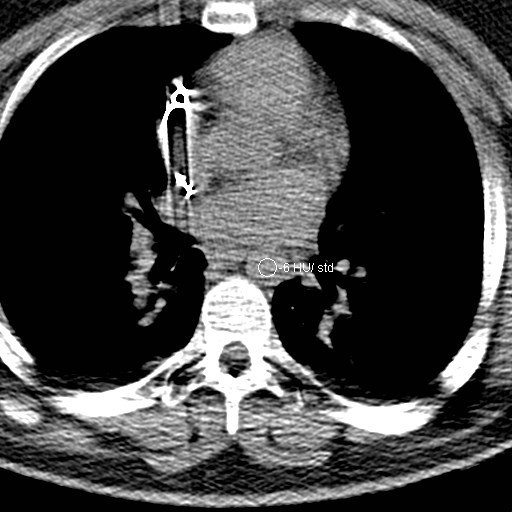 File:Neck CT angiogram (intraosseous vascular access) (Radiopaedia 55481-61945 Axial Monitoring 3).jpg