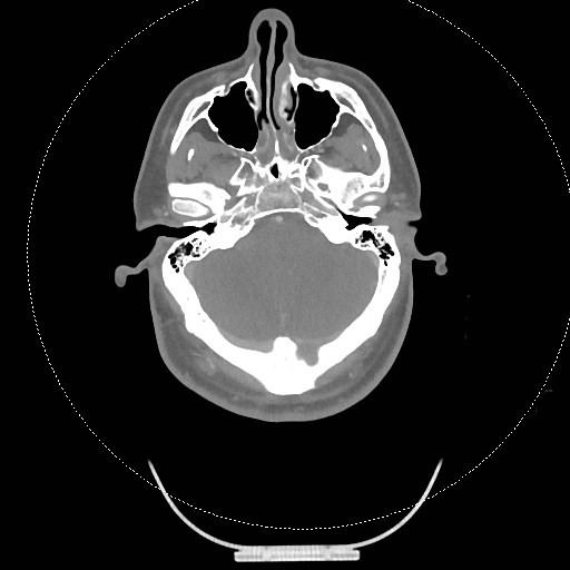 Neck CT angiogram (intraosseous vascular access) (Radiopaedia 55481-61945 B 269).jpg