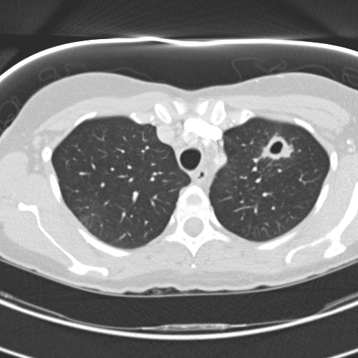 Necrobiotic pulmonary nodules - Crohn disease (Radiopaedia 20723-20631 Axial lung window 34).jpg