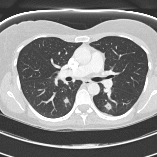 Necrobiotic pulmonary nodules - Crohn disease (Radiopaedia 20723-20631 Axial lung window 62).jpg