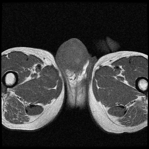 File:Necrotizing epididymo-orchitis with intra-testicular abscess (Radiopaedia 29397-29860 Axial T1 13).jpg