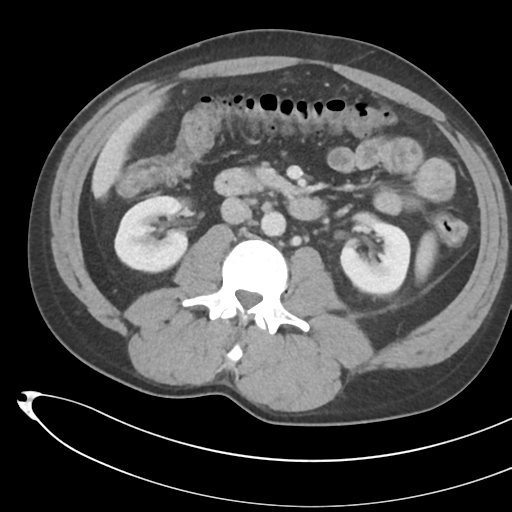 File:Necrotizing pancreatitis with acute necrotic collections (Radiopaedia 38829-41012 B 40).png