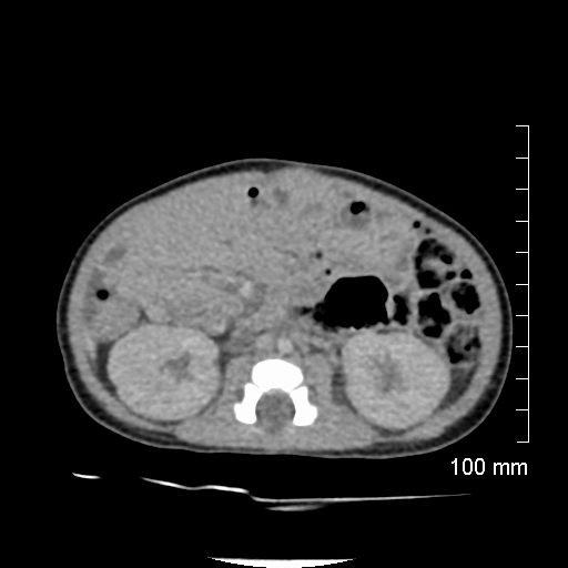 File:Neonatal neuroblastoma (Radiopaedia 56651-63438 Axial non-contrast 45).jpg