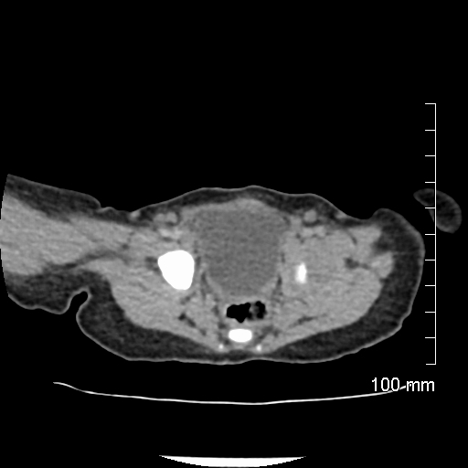 File:Neonatal neuroblastoma (Radiopaedia 56651-63438 Axial non-contrast 73).jpg