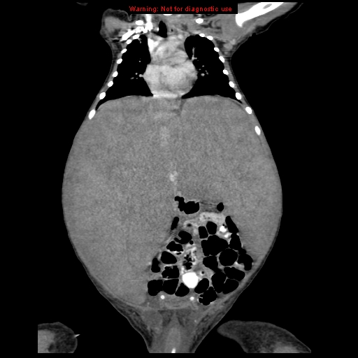 File:Neonatal neuroblastoma (Radiopaedia 9564-10223 B 60).jpg