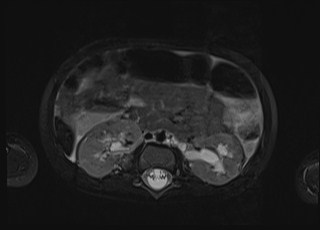 Neonatal prostatic utricle abscess - cyst (Radiopaedia 69511-79394 Axial T2 fat sat 47).jpg