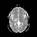 File:Neuro-Behcet's disease (Radiopaedia 21557-21505 Axial ADC 11).jpg