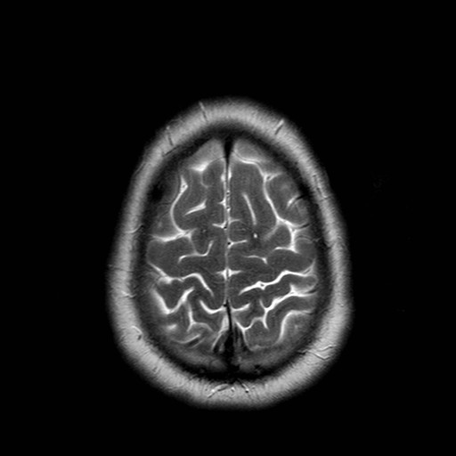 File:Neuro-Behcet's disease (Radiopaedia 21557-21505 Axial T2 20).jpg