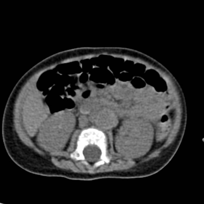 Neuroblastoma with skull metastases (Radiopaedia 30326-30960 Axial non-contrast 31).jpg