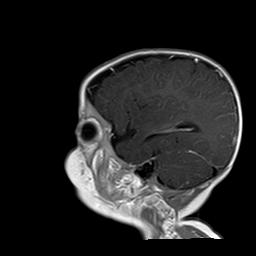 File:Neurofibromatosis type 1 (Radiopaedia 30089-30671 Sagittal T1 C+ 2).jpg