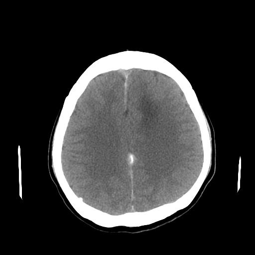 File:Neurofibromatosis type 2 (Radiopaedia 25389-25637 Axial non-contrast 18).jpg
