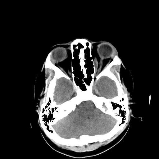 File:Neurofibromatosis type 2 (Radiopaedia 25389-25637 Axial non-contrast 5).jpg