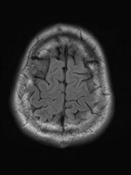 File:Neurofibromatosis type 2 (Radiopaedia 44936-48838 Axial FLAIR 21).png
