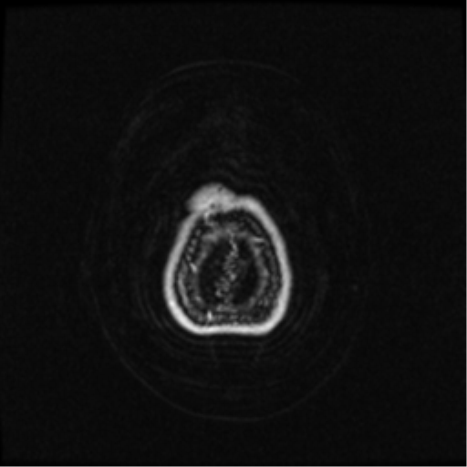 Neurofibromatosis type 2 (Radiopaedia 45229-49244 Axial T1 C+ 113).png