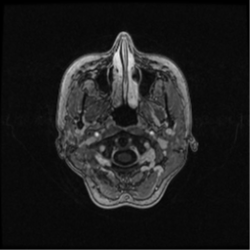 Neurofibromatosis type 2 (Radiopaedia 45229-49244 Axial T1 C+ 20).png