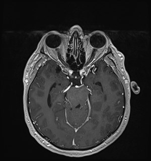 Neurofibromatosis type 2 (Radiopaedia 79097-92049 Axial T1 C+ 81).jpg