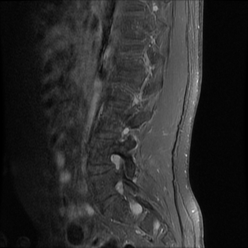 File:Neurofibromatosis type 2 (spinal manifestations) (Radiopaedia 53943-60070 K 12).png