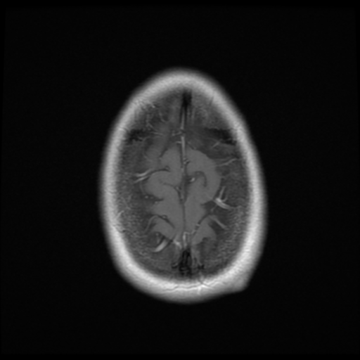 File:Neurofibromatosis type 2 - bilateral acoustic neuromata (Radiopaedia 40060-42566 Axial T1 C+ 20).png