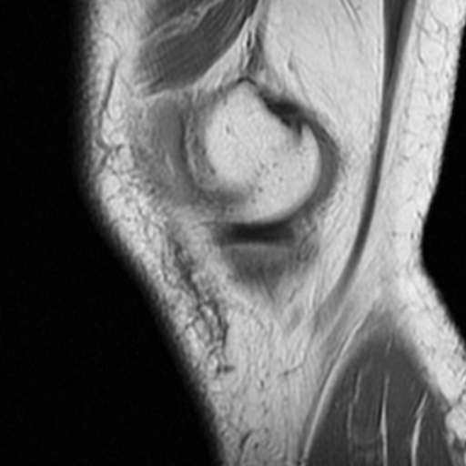 File:Non-displaced patella fracture (Radiopaedia 15932-15582 Sagittal T1 2).jpg