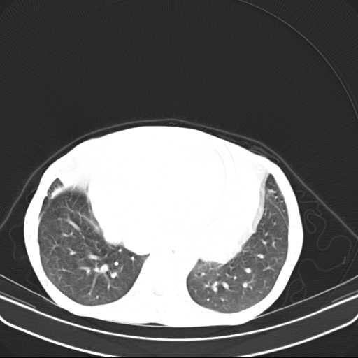 File:Non hodgkin lymphoma of the mediastinum (Radiopaedia 20814-20729 Axial lung window 41).jpg