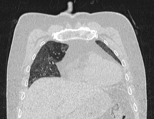 Non specific interstitial pneumonia (NSIP) (Radiopaedia 89725-106798 Coronal lung window 20).jpg