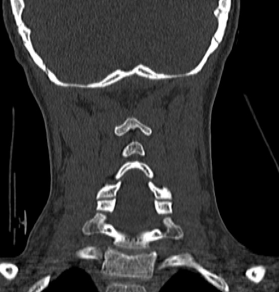 File:Normal CT cervical spine - 12-year-old (Radiopaedia 55352-61775 Coronal bone window 151).jpg