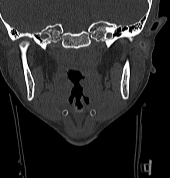 File:Normal CT cervical spine - 12-year-old (Radiopaedia 55352-61775 Coronal bone window 2).jpg