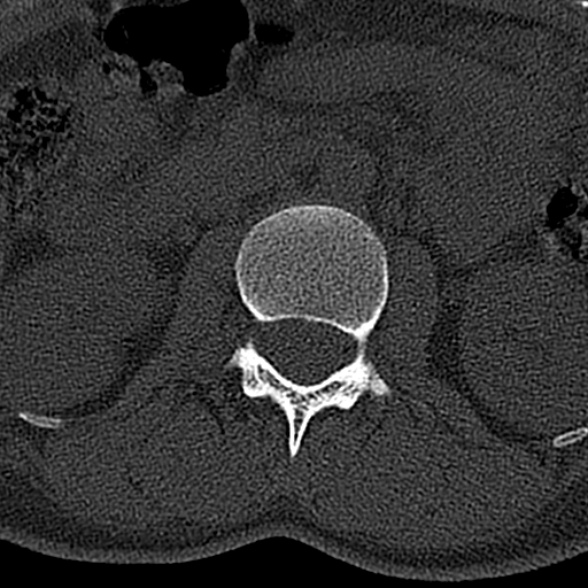 File:Normal CT lumbar spine (Radiopaedia 53981-60118 Axial bone window 25).jpg